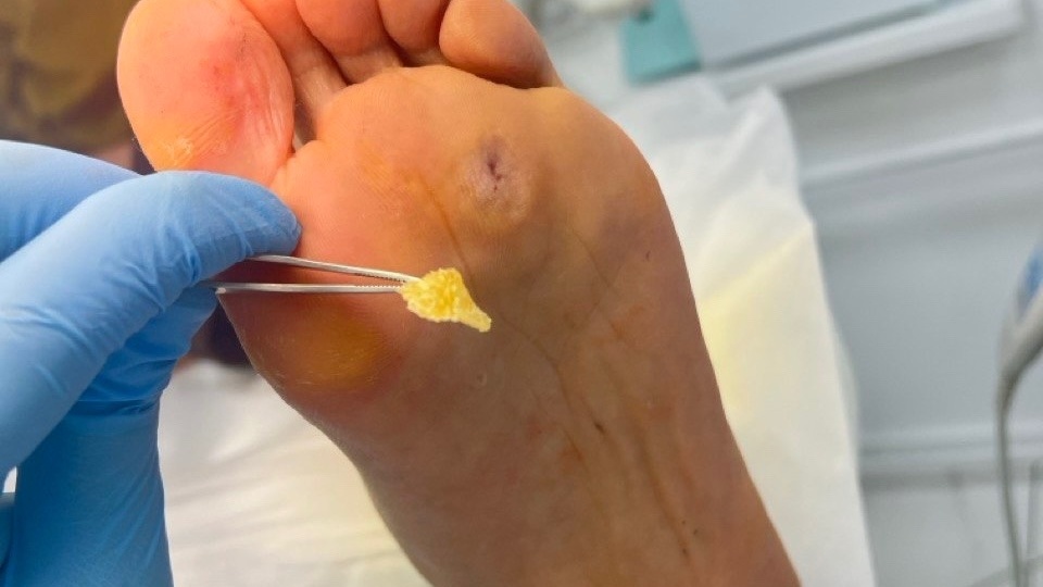 Стержневые мозоли: не просто косметический дефект! Причины, лечение