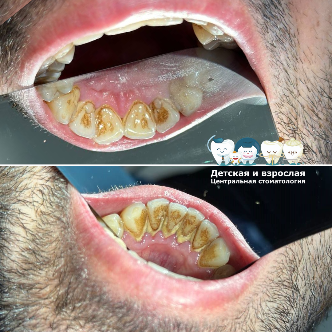 На фото ДО профессиональной чистки зубов в Детской и взрослой Центральной стоматологии в Тольятти