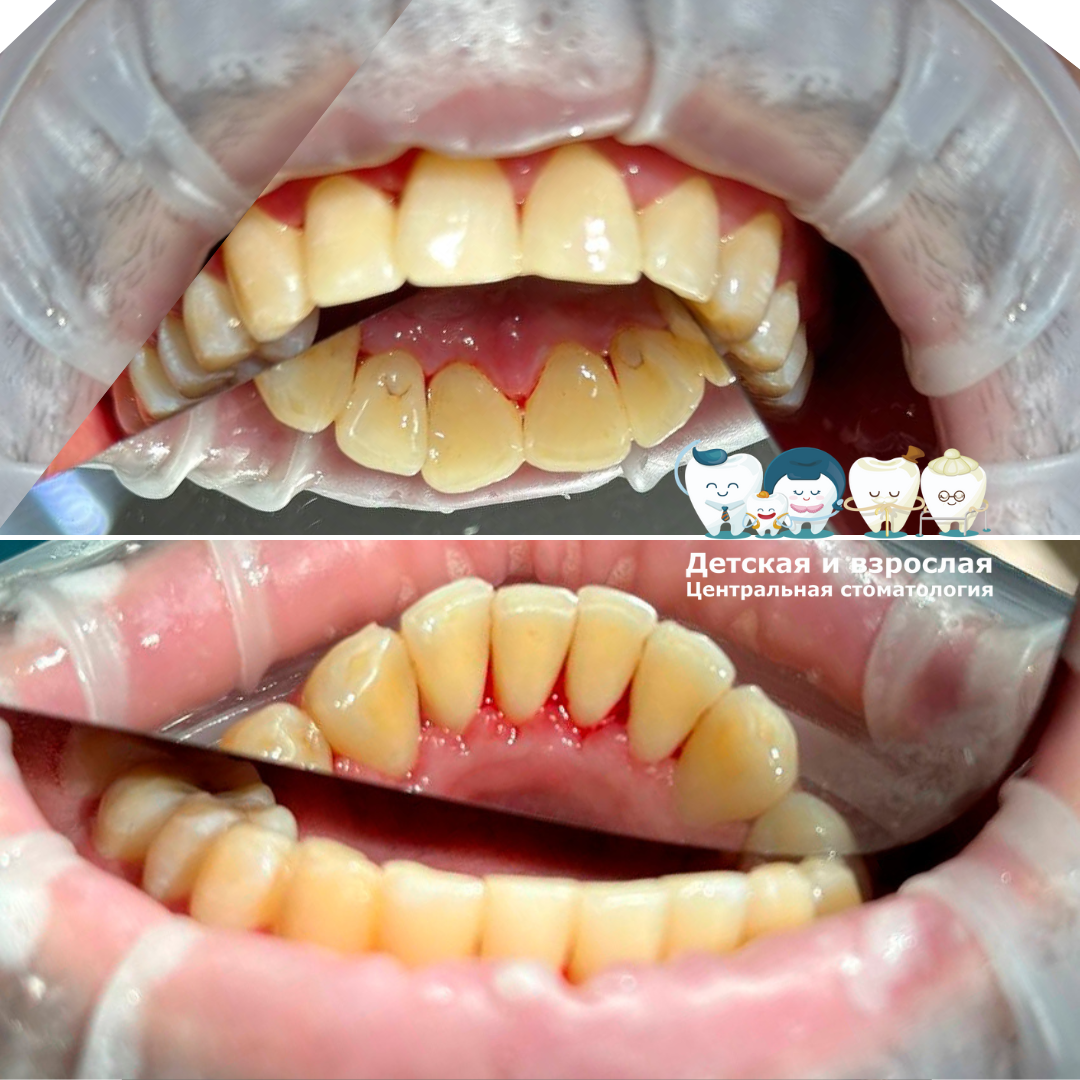 На фото ПОСЛЕ профессиональной чистки зубов в Детской и взрослой Центральной стоматологии в Тольятти