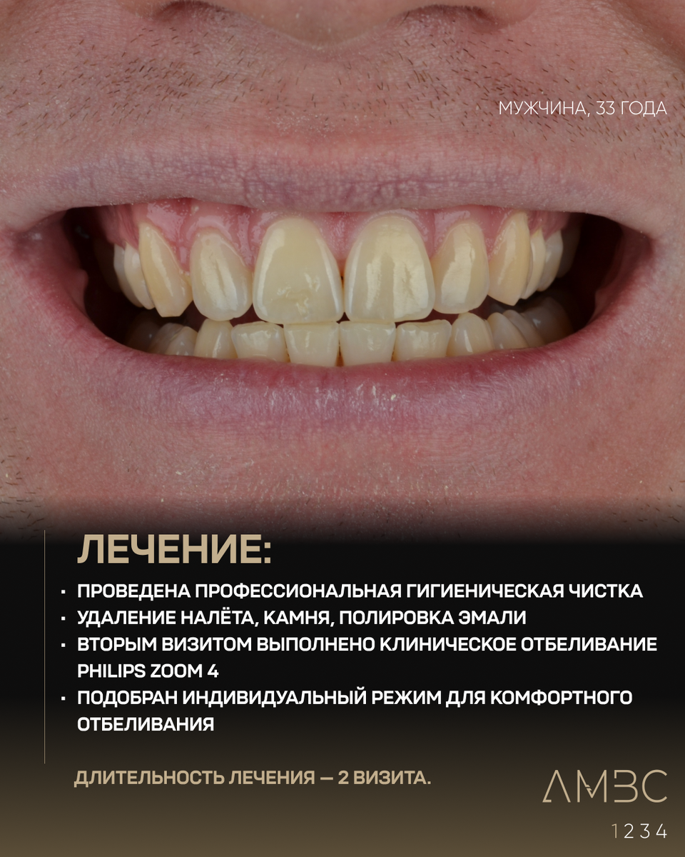 До отбеливания Philips ZOOM 4 