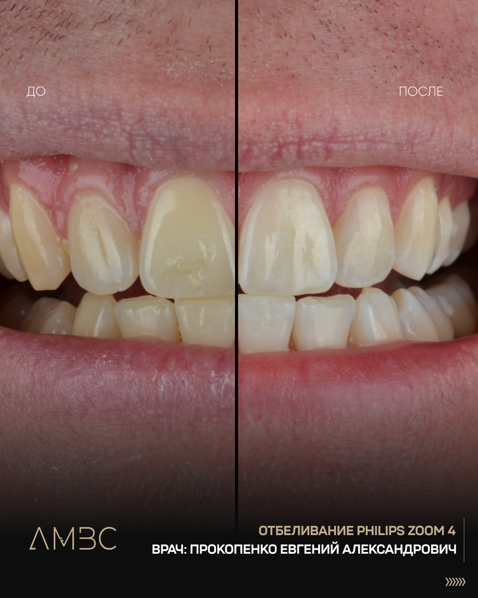 Отбеливание ZOOM 4: эффективное отбеливание до 8 тонов за 1 сеанс, безопасно для эмали и мягких тканей, безболезненная процедура