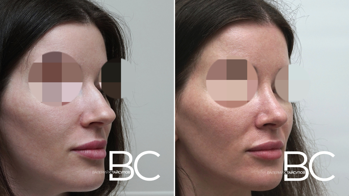 Пластический хирург Стайсупов В.Ю., ЗАКРЫТАЯ РИНОПЛАСТИКА 6 месяцев после операции