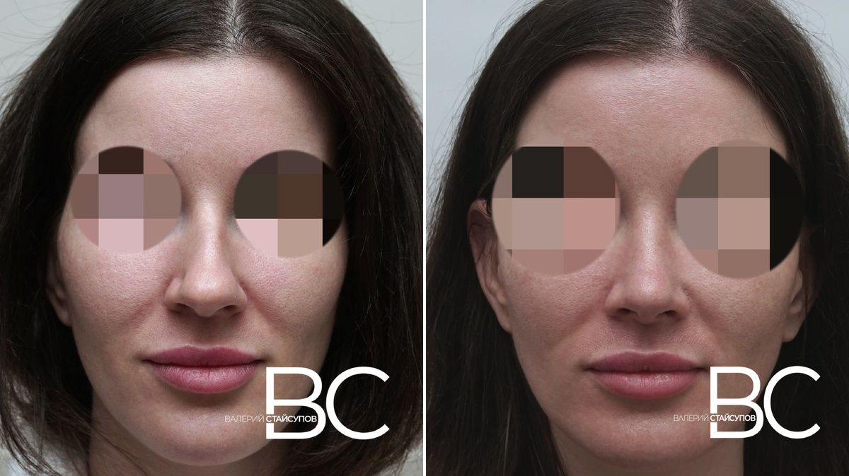 Пластический хирург Стайсупов В.Ю., закрытая ринопластика, 6 месяцев после операции