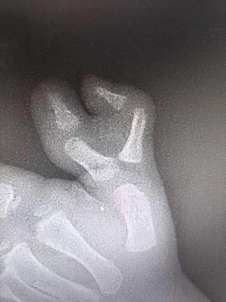  Подмосковные врачи удалили ребенку шестой палец на руке / Фото: Пресс-служба министерства здравоохранения Московской области