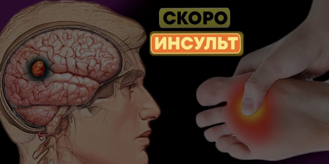 Тихий инсульт: семь скрытых признаков по версии неврологов