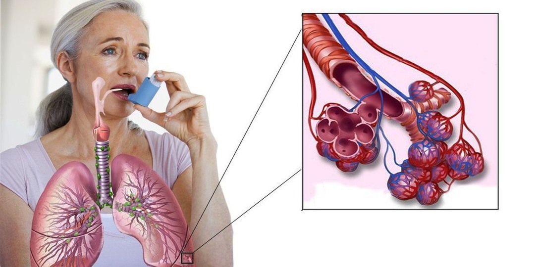 Астма — не приговор, а вызов, с которым можно научиться жить