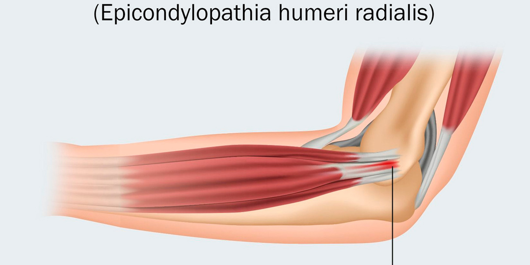 «Локоть теннисиста»: почему болит локоть, когда вы носите сумку или работаете за мышкой. И причем тут ваше предплечье.
