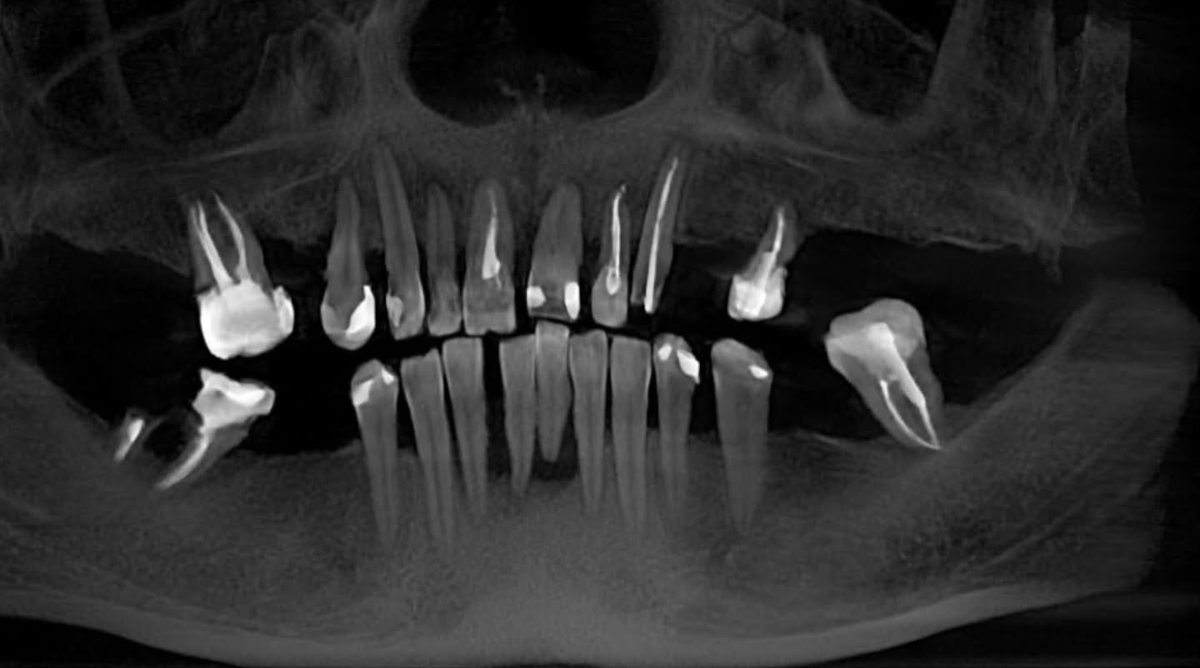 Компьютерная томограмма нашей пациентки на момент обращения в клинику. 