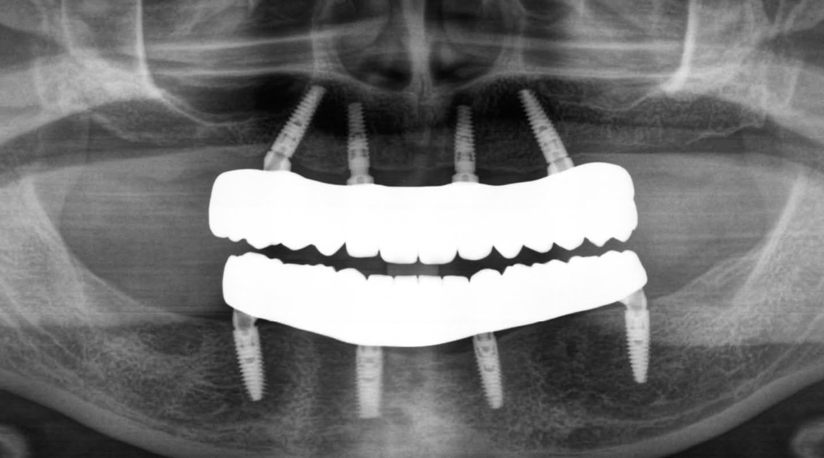 Компьютерная томограмма нашей пациентки после операции.