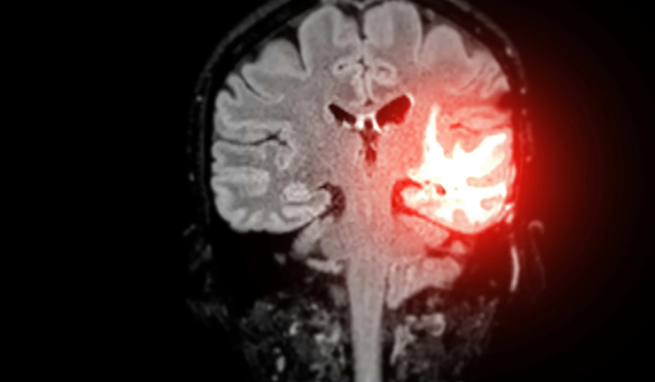 Российский прибор определяет границы опухоли мозга по её свечению. Хирурги больше не удаляют лишнее