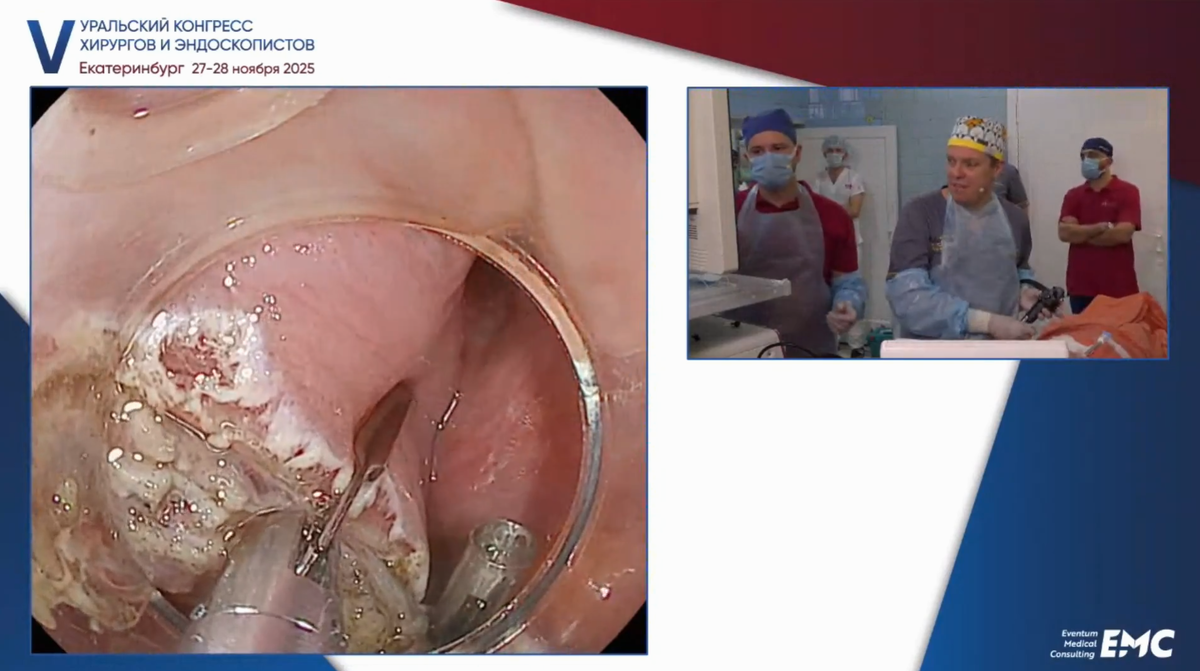 Иван Юрьевич Недолужко, эндоскопическая крикофарингоэзофагомиотомия у пациента с дивертикулом Ценкера
