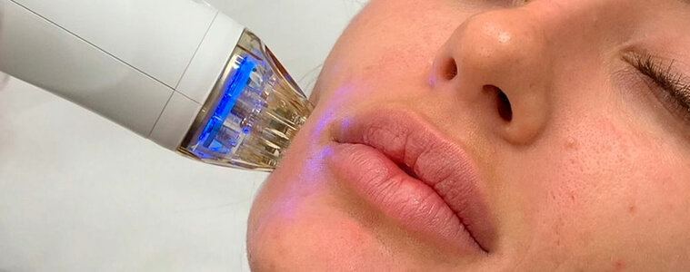 Процедура RF-лифтинг лица