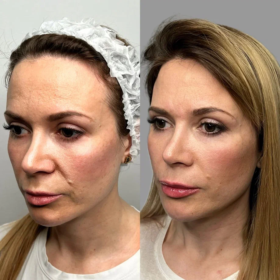 Реальныое фото нашей клиентки до и после процедуры