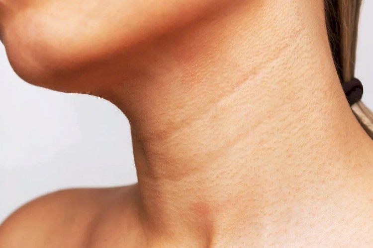 Пример колец Венеры на шее