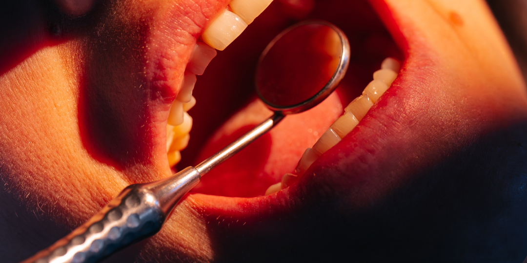 Пересадка зуба (Аутотрансплантация)