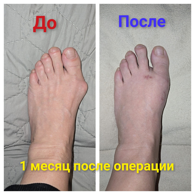    Пациентка из Усинска поблагодарила кировских врачей за успешную операцию на стопе