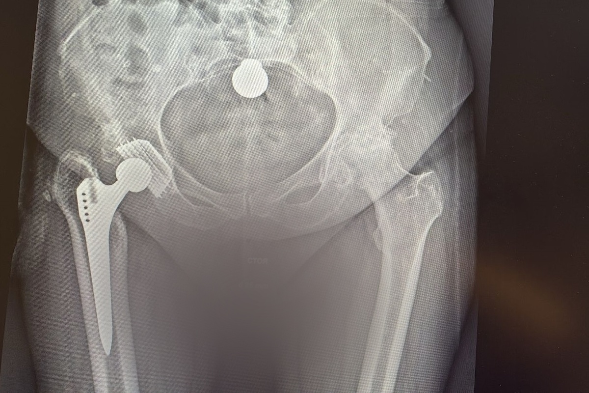 Врачам предстояло сохранить привычную биомеханику тазобедренного сустава для пациентки