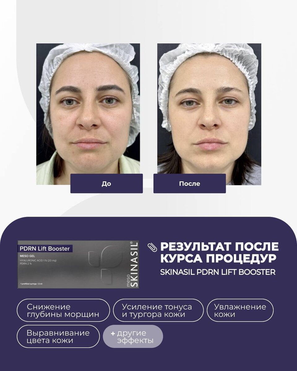 Результат работы с препаратом PDRN Lift Booster от SKINASIL®