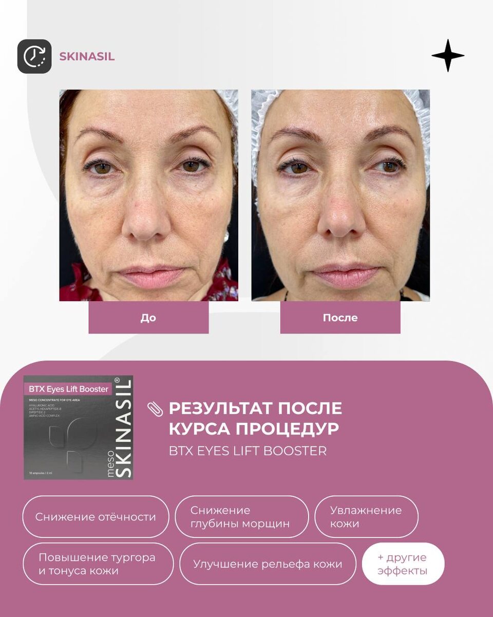 Результат после курса процедур BTX Eyes Lift Booster, мезобустер SKINASIL®