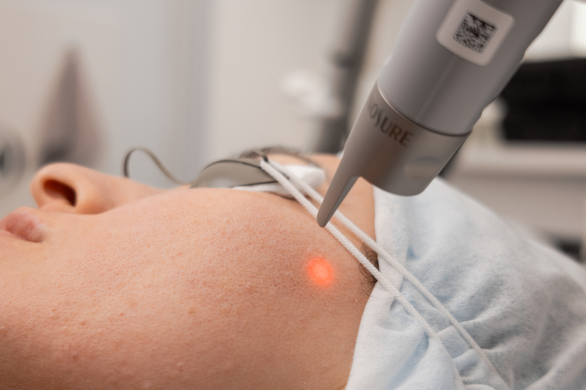 Лазер нацелен на конкретную клетку
Проблемная клетка содержит больше меланина – именно его PicoSure Pro и «считывает».