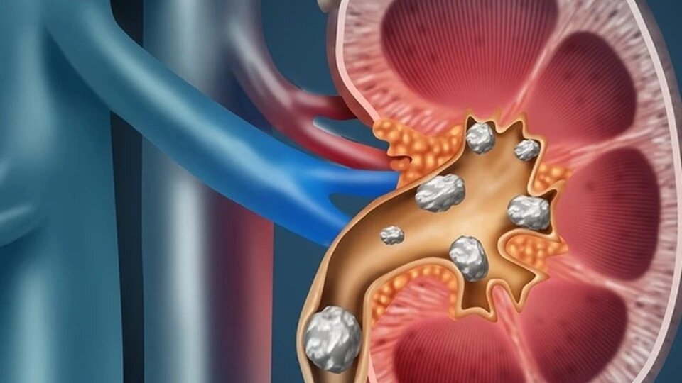Камни в почках: неожиданная боль и как с ней справиться — просто о сложном
