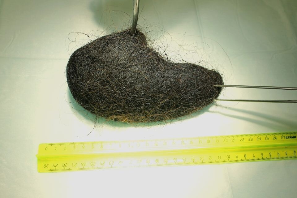    Волосы, удаленные из желудка. Источник: vk.com/dgkb7barnaul