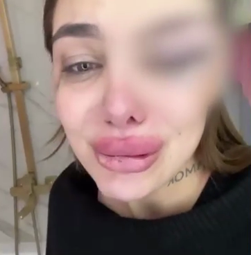 Последствия побоев