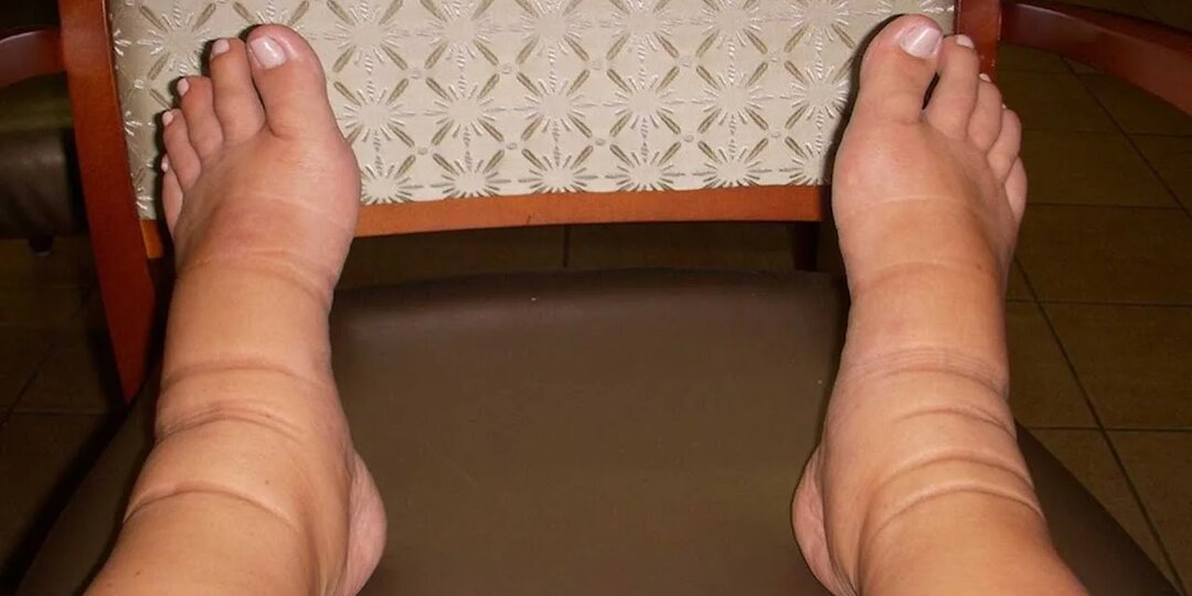 Отеки ног: когда это сигнал, а не просто усталость