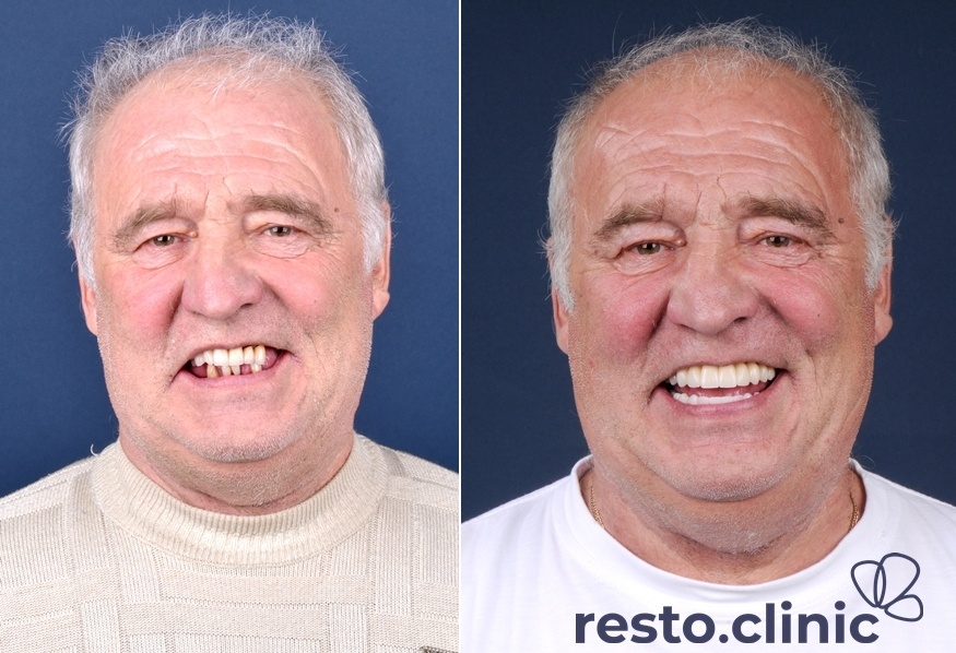 All-on-4 в стоматологической клинике Ресто в Ижевске