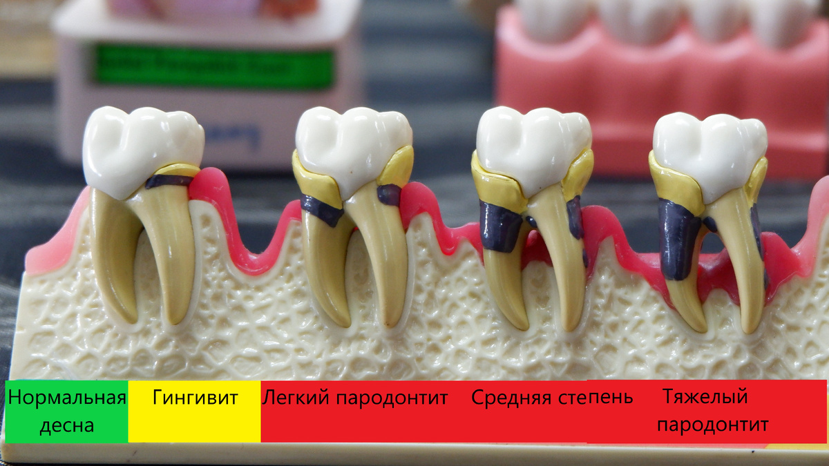 Наглядные стадии заболевания десен