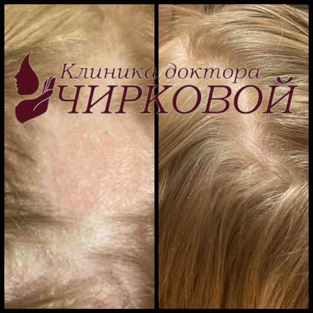 Работа с очаговой алопецией у пациентки. Курс карбокситерапии направлен на восстановление микроциркуляции, активацию волосяных фолликулов и снижение выпадения. В работе использовался комплексный подход к лечению.