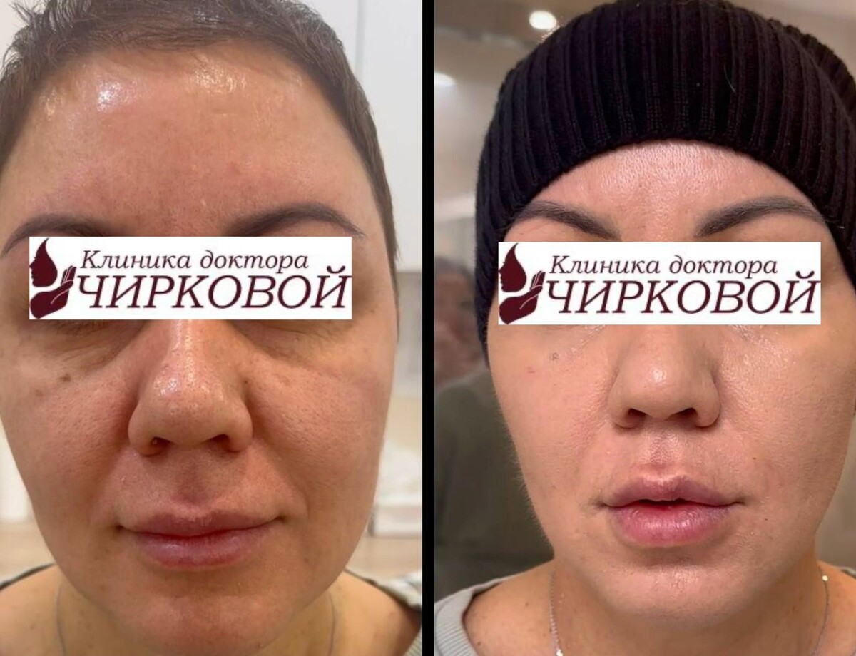 Результат пациентки после курса карбокситерапии: ткани обновлены, отеки уменьшены, птоз заметно сокращен.