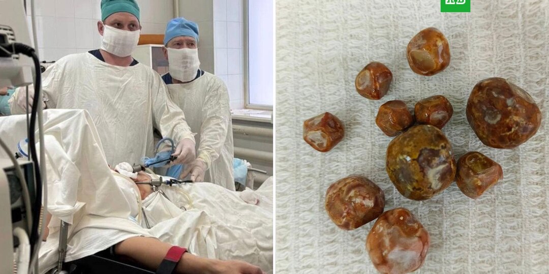 Врачи удалили 10 камней у подростка, питавшегося чипсами и газировкой