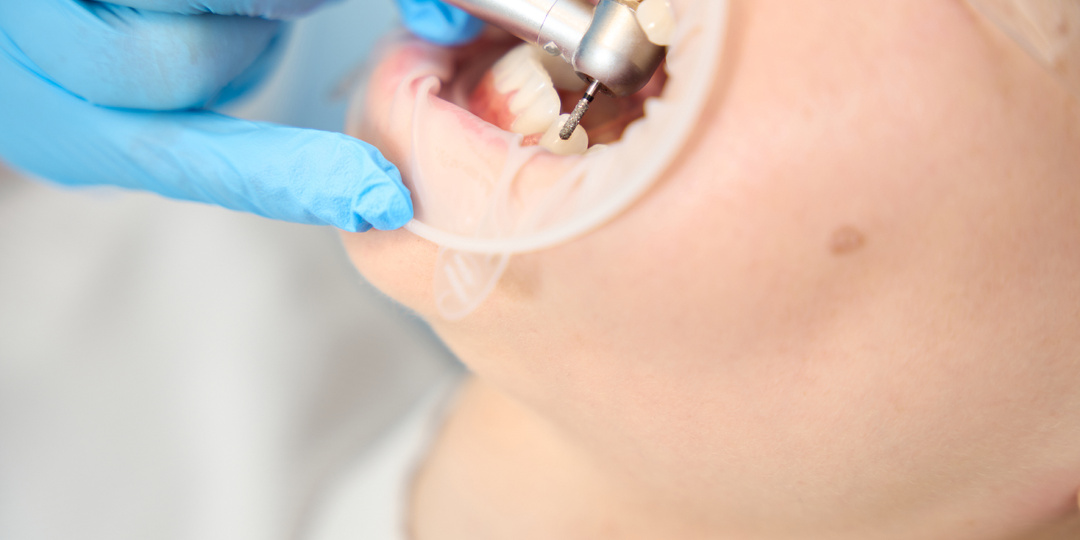 Почему важно лечить кариес на ранней стадии