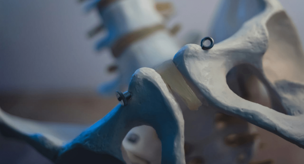 Укрепление тазового дна при ожирении