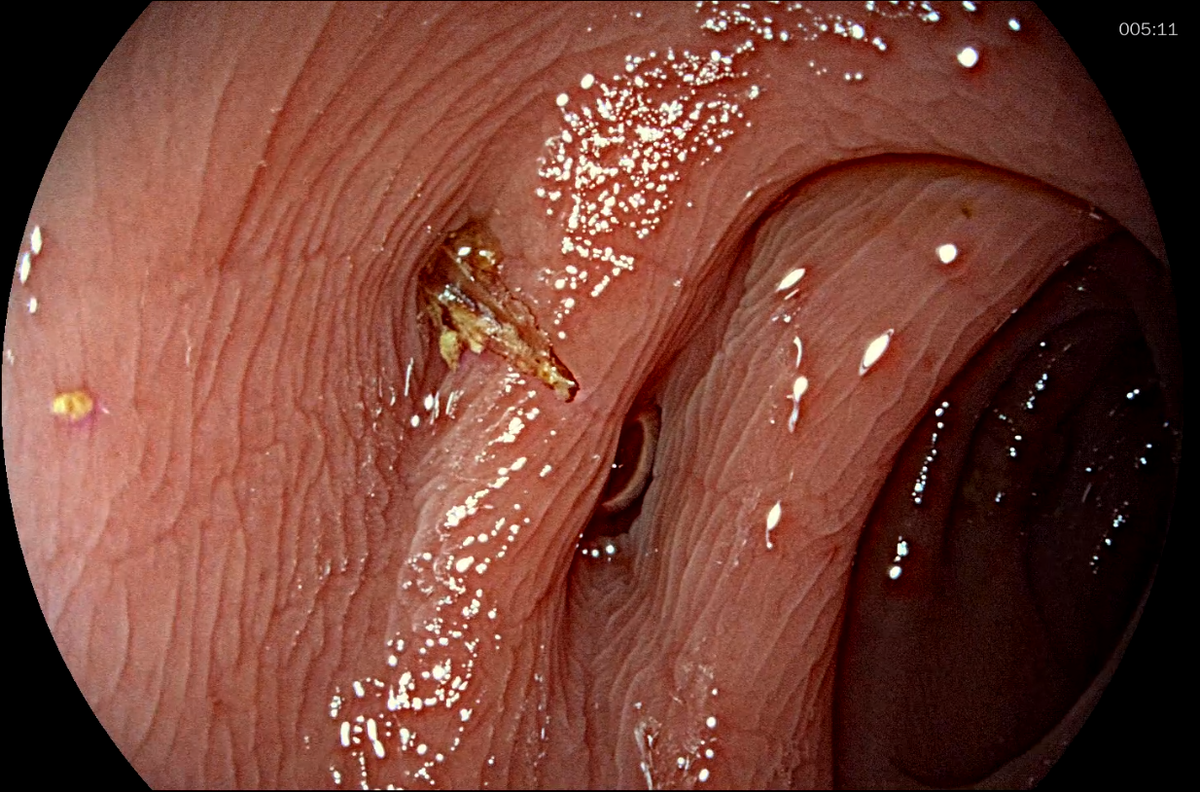 Инородное тело (рыбья кость) в стенке дивертикула сигмовидной кишки