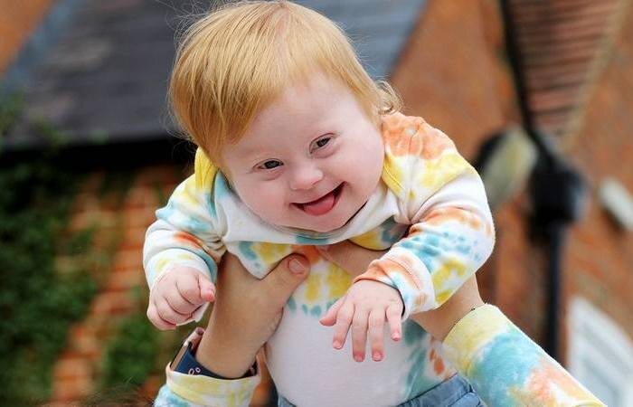Малыш с синдромом Дауна.