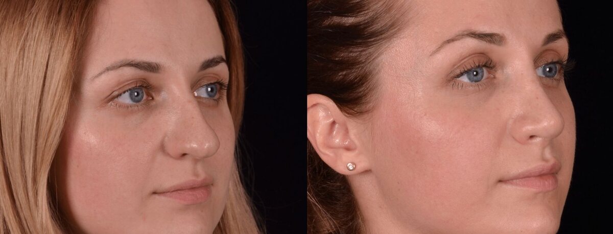 Ринопластика толстого носа с опущенным кончиком фото до и после. Фото с сайта Д.Р. Гришкяна. Имеются противопоказания, требуется консультация специалиста