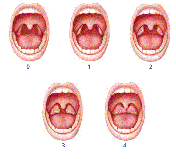 Схематичное изображение различной степени увеличения небных миндалин