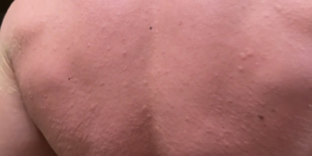 Семь сигналов диабета: эндокринолог о скрытых угрозах