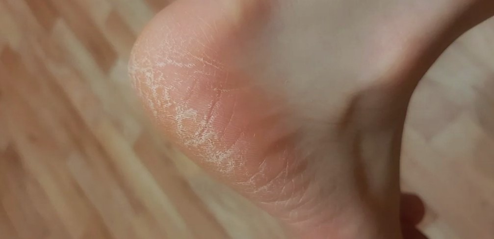 Это не только косметический дефект, но и потенциальный сигнал о необходимости проверить работу печени и рацион питания.