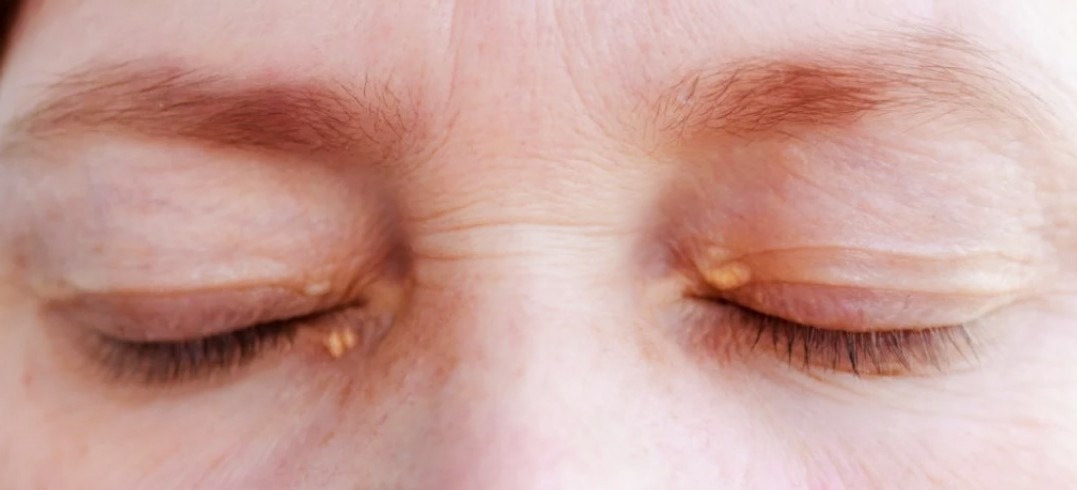 Сегодня я хочу рассказать о 12 ранних признаках цирроза, на которые стоит обратить внимание, чтобы ваша печень оставалась здоровой.