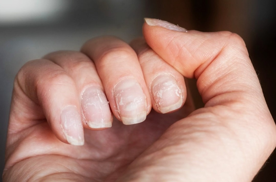 Печень влияет на усвоение питательных веществ, особенно витаминов и микроэлементов, которые важны для здоровья ногтей. Если вы замечаете подобные изменения, это повод обратить внимание на состояние печени.