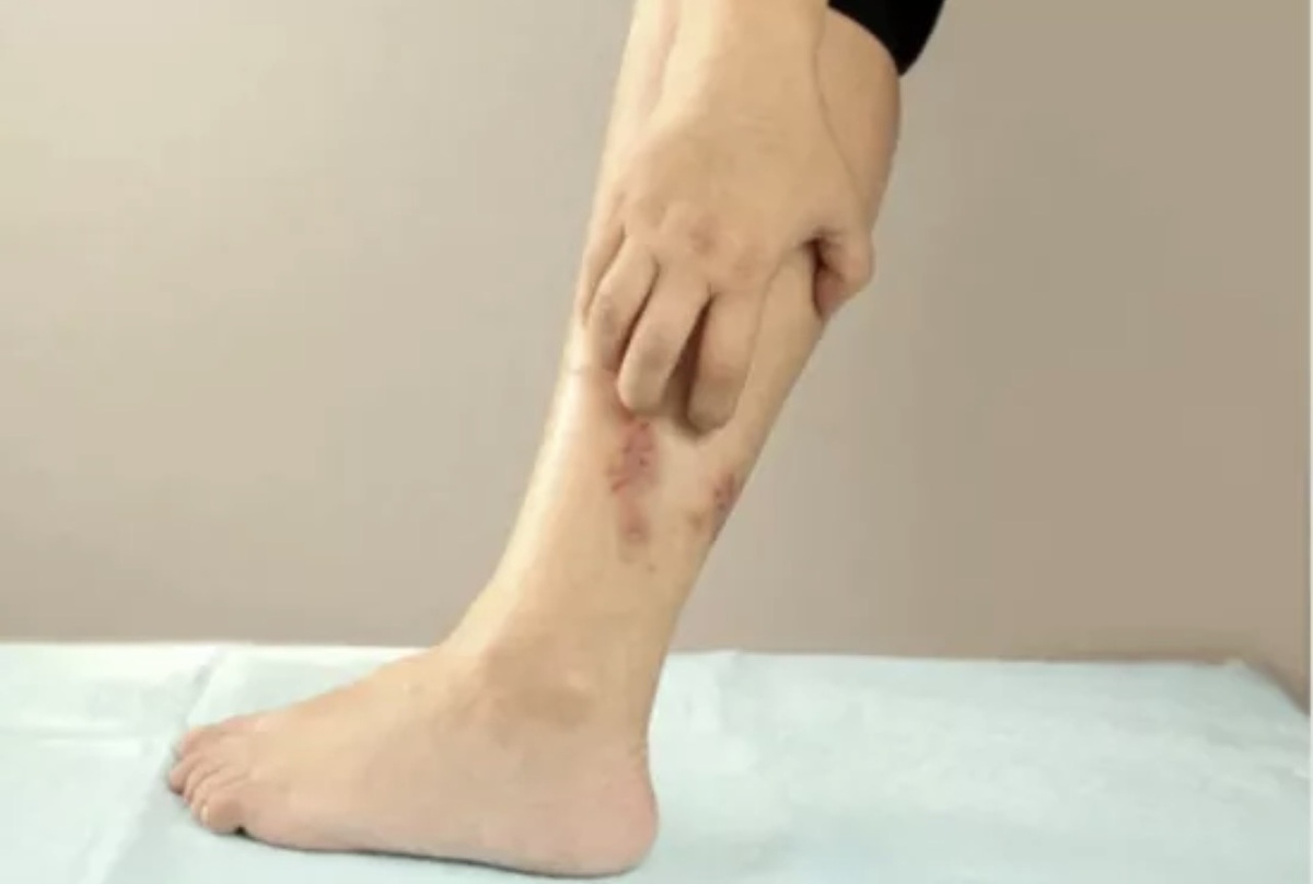 Трофическая язва 