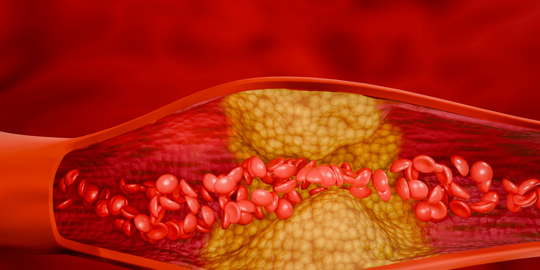 Как атеросклероз крадёт здоровье — и как его остановить