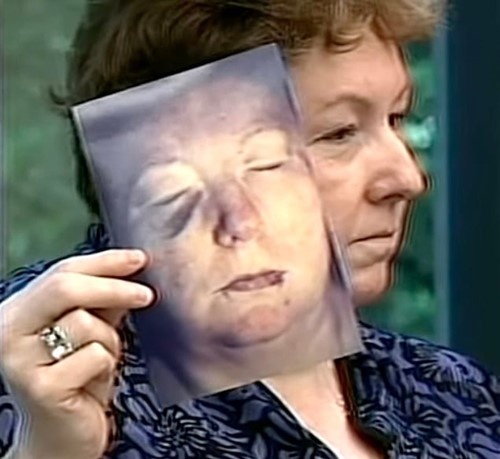 Ссадины и синяки на лице Сьюзен после нападения. Фото: Crime Talk / YouTube