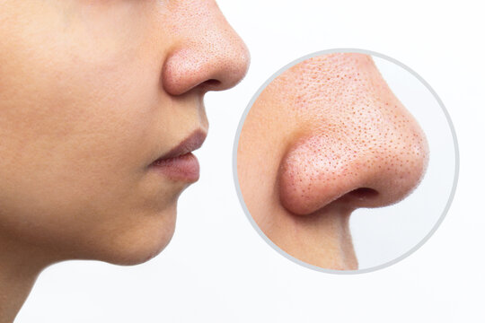 Пример расширенных пор в зоне носа