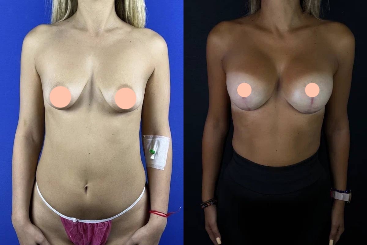 На фото моя пациентка. После родов и ГВ наблюдался выраженный птоз молочных желёз и растяжение ареол. Выполнили вертикальную подтяжку груди с имплантами