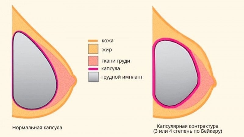 Капсульная контрактура груди. Источник: https://goncharovsd.ru/kapsulnaya-kontraktura