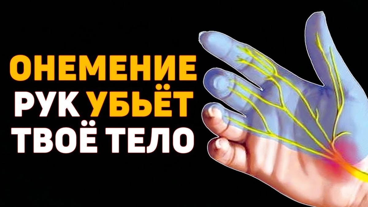 Когда Онемение Левой Руки Может Закончиться Инсультом
